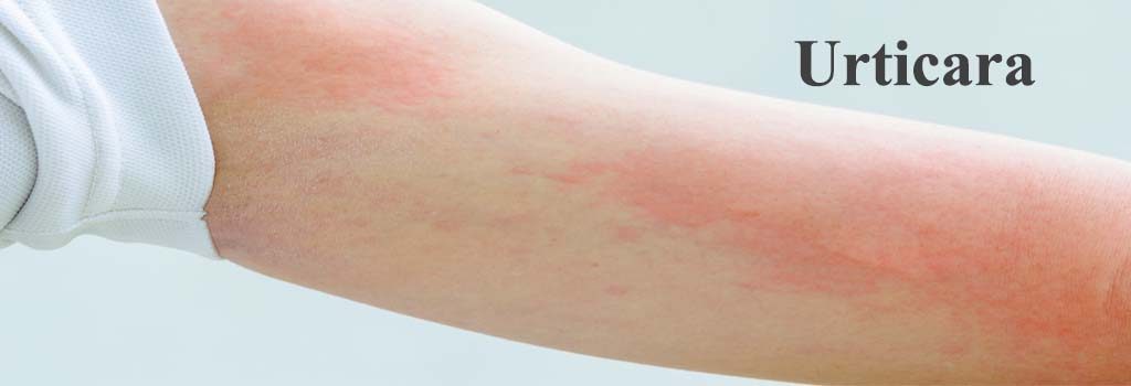 Homeopathic Treatment And Medicines For Urticaria Hivesnettle Rash
