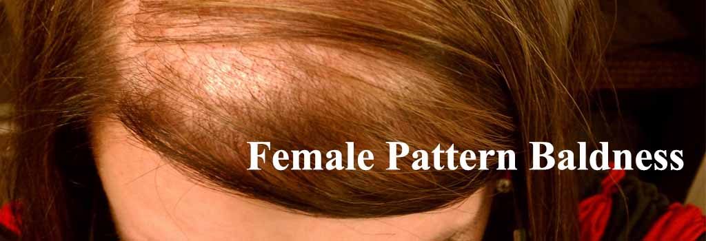 Pattern Female Balding Pattern Female Balding